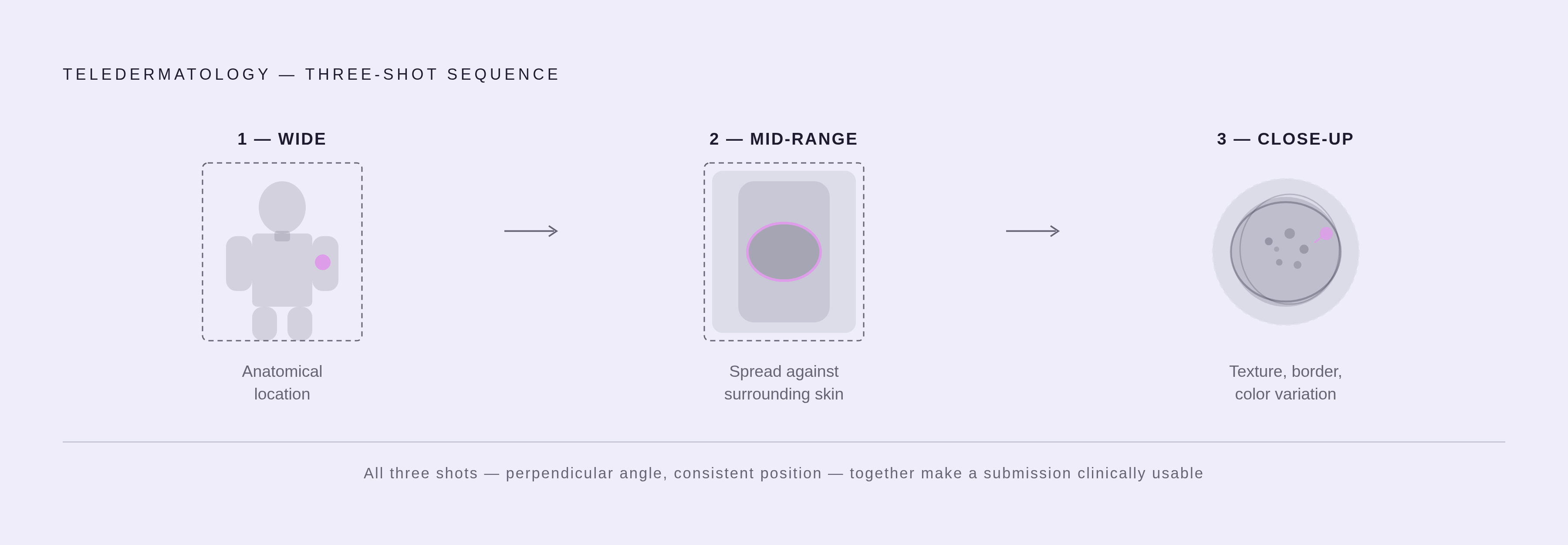Diagram: The Three-Shot Clinical Sequence. Visualizes: Visualize the three-shot sequence required for a clinically usable teledermatology photo submission: (1) Wide shot — anatomical location, answering 'where on the body is this'; (2) Mid-range…