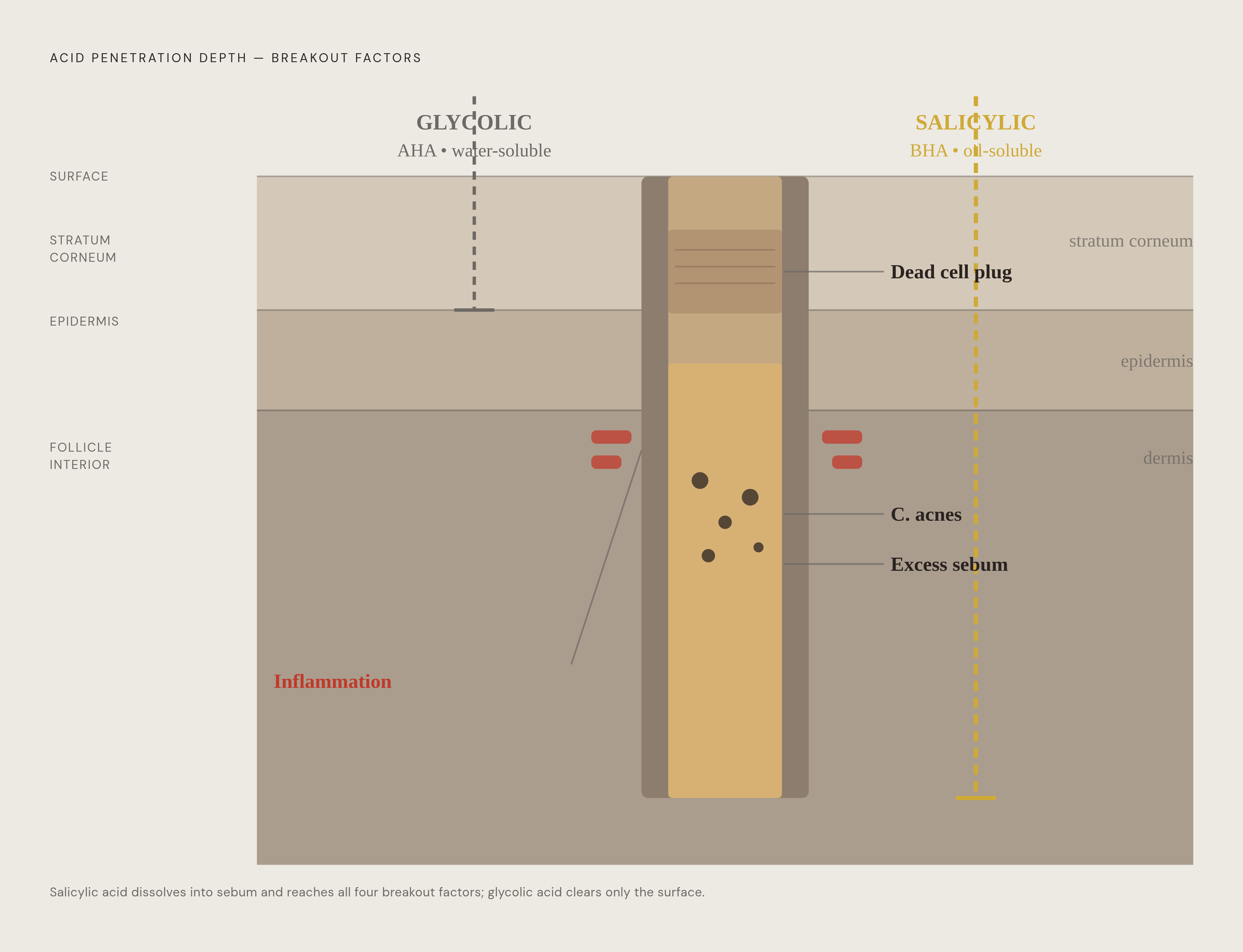 Diagram: Four Stages of a Breakout — and Where Each Acid Reaches. Visualizes: Illustrate the four converging factors that create a breakout inside the pilosebaceous follicle, showing the depth at which each acid acts.