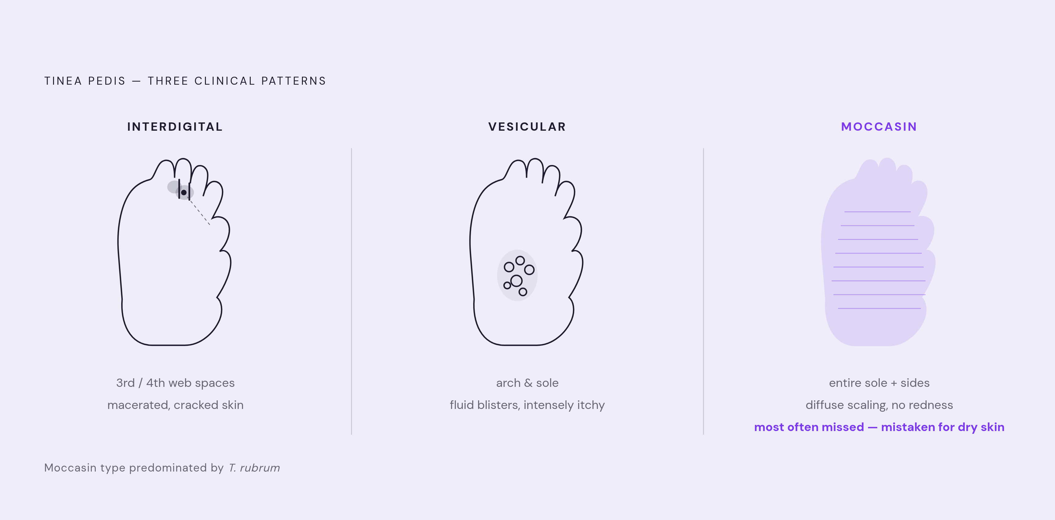 Diagram: Three Faces of Athlete's Foot. Visualizes: Visualize the three distinct clinical patterns of tinea pedis as a side-by-side comparison strip, each with a short label and its key distinguishing features.