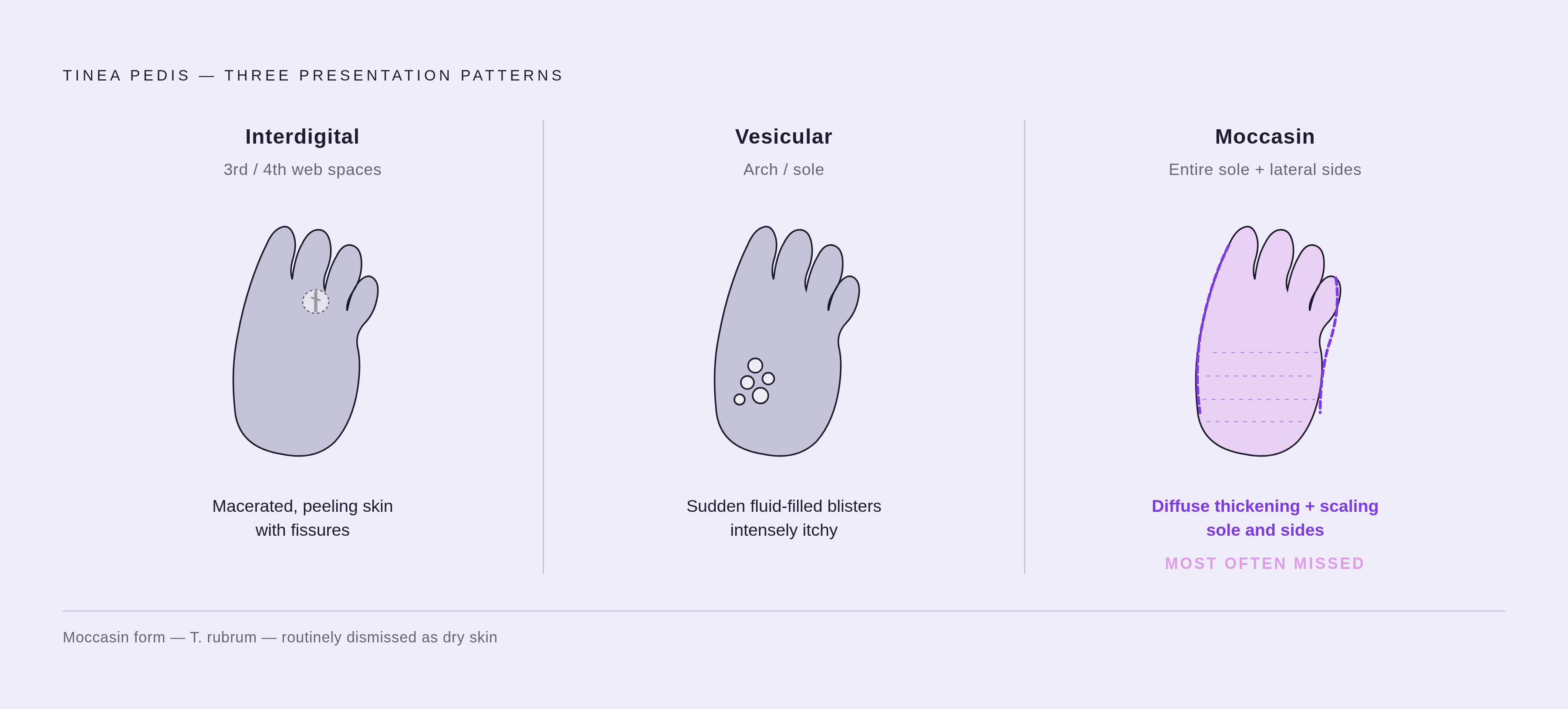 Diagram: Three Faces of Athlete's Foot. Visualizes: Visualize the three distinct presentation patterns of tinea pedis as a side-by-side comparison strip, each with a label, dominant location, and key visual feature.
