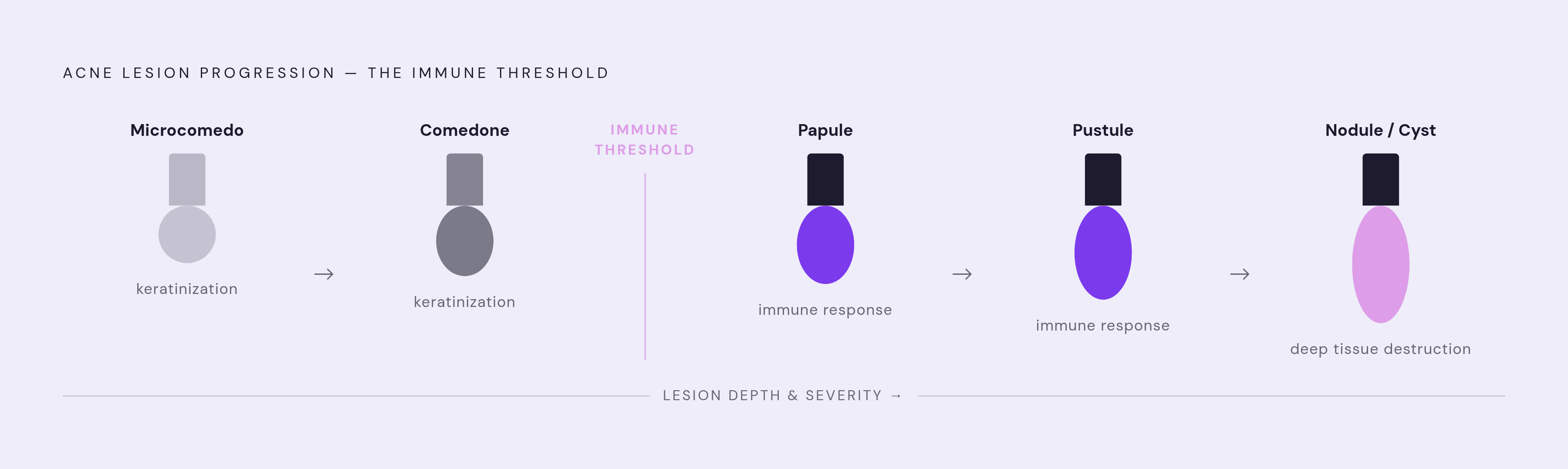 Diagram: From Microcomedo to Cyst: The Acne Lesion Progression. Visualizes: Show a linear progression through five stages of acne lesion development, each representing a categorically different biological state: (1) Microcomedo — invisible…