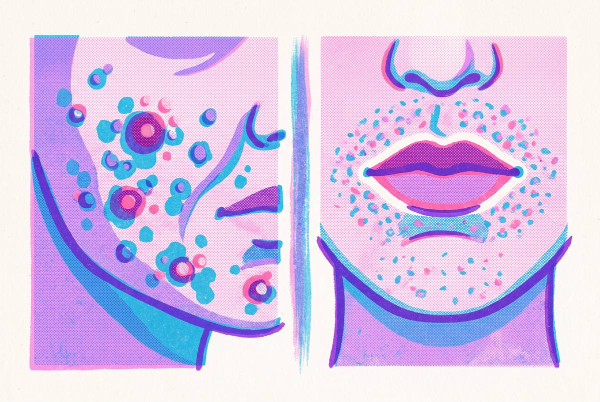 Cover illustration for “Acne Versus Perioral Dermatitis Visual Identification”
