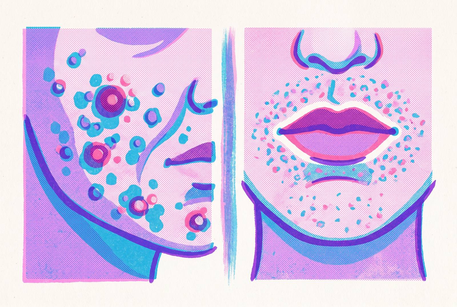 Cover illustration for “Acne Versus Perioral Dermatitis Visual Identification”