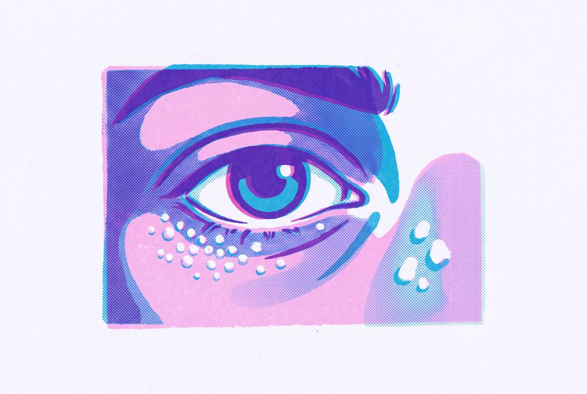 Cover illustration for “Milia Under the Eyelid Versus Other White Bumps”