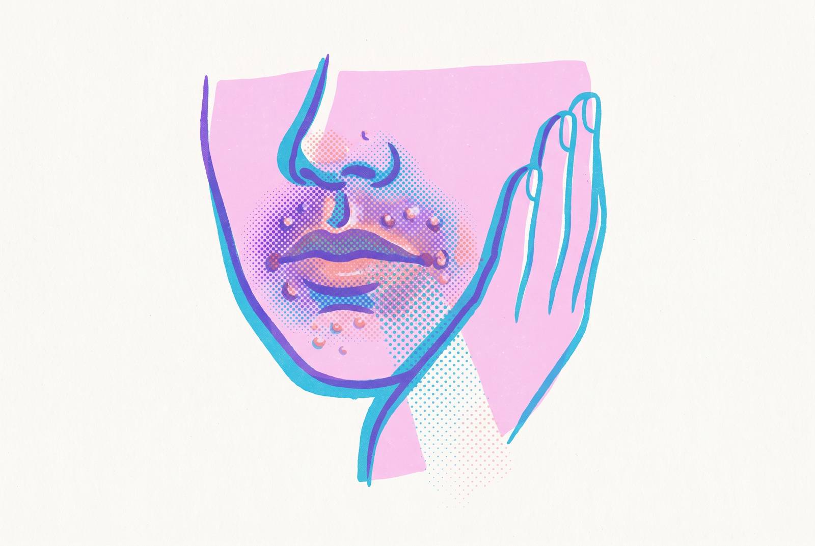 Cover illustration for “Perioral Dermatitis Treatment and Steroid Withdrawal”