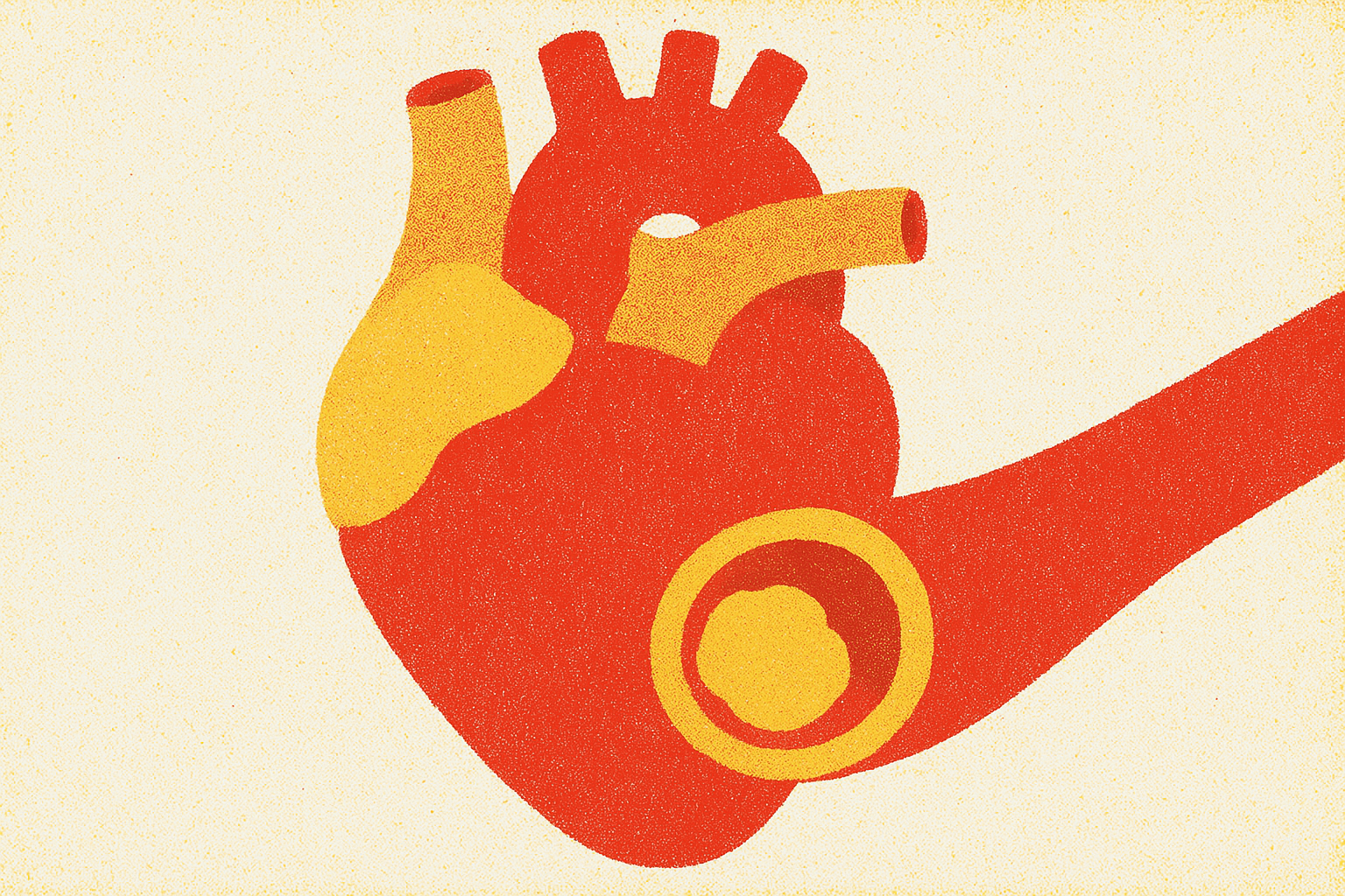 Cover illustration for “Coronary Artery Calcium Score and Lifetime Cardiovascular Risk”