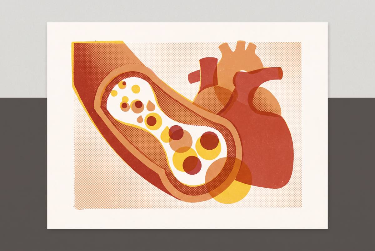 Cover illustration for “ApoB as a Cardiovascular Risk Marker Beyond LDL Cholesterol”
