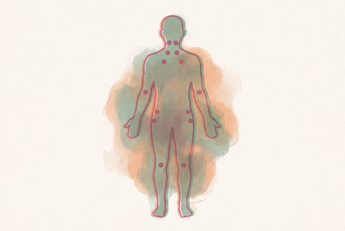 Cover illustration for “Fibromyalgia Tender Points vs Widespread Pain Criteria”