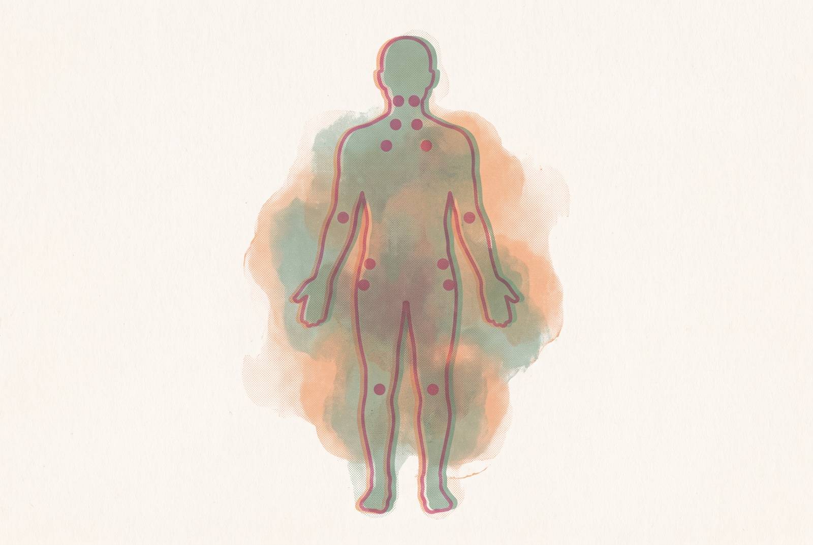 Cover illustration for “Fibromyalgia Tender Points vs Widespread Pain Criteria”